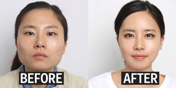 eyelid-surgery-befor-and-after
